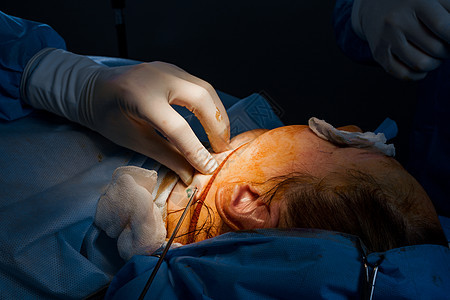 下巴吸脂手术 吸出女性下巴部位的脂肪 脸型矫正 老年人的美容程序工具手术治疗皮肤化妆品护理外科数字橘皮身体图片