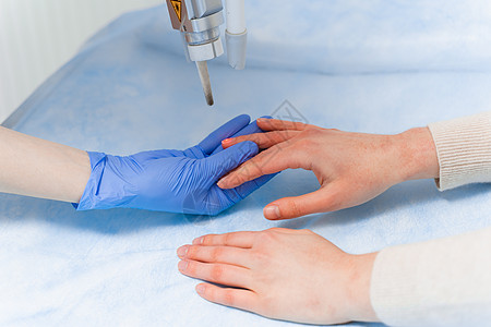 白喉病的激光治疗 在门诊部的一个年轻女孩手上感染真菌 该名女孩患有青蒿素综合症玻璃病学皮炎症状咨询考试药物疾病脚趾手指图片