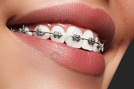 有牙套的美丽的白牙 牙科护理照片 女人微笑与矫形配饰品 整形治疗女士保健快乐宏观牙齿女性嘴唇金属制品女孩图片