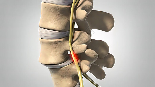 Disc 变化和神经诱捕脊柱光盘骨头颅骨椎骨老年药品老化疼痛磁盘图片