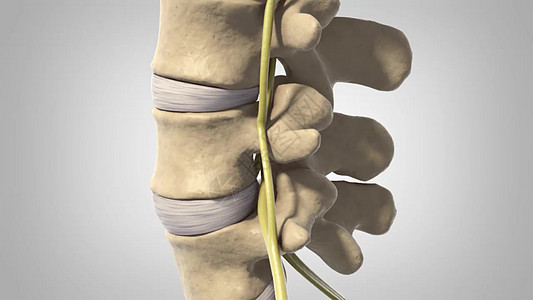Disc 变化和神经诱捕椎间腰椎颅骨痛苦脊椎脊柱骨赘状况压缩卫生图片