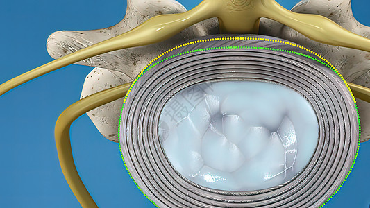 Disc 系统滑落和神经压力光盘治疗磁盘款待疾病插图骨科椎骨腰椎身体图片