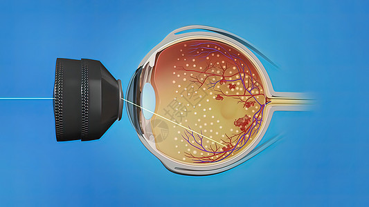 激光外科 眼激光治疗手术矫正视网膜眼球医生散光药品眼睛帮助手术室背景图片