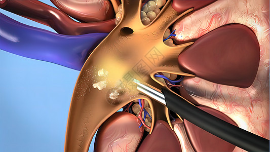 人体肾结石的历程插图医疗尿液信息药品生理艺术白色微生物学科学背景图片