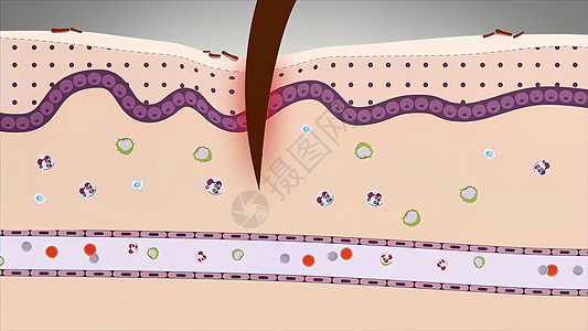 细菌 创伤 毒素 热或其他任何原因导致的炎症 组织损伤白细胞抗原细胞因子细胞树突皮肤图表疾病疼痛科学图片