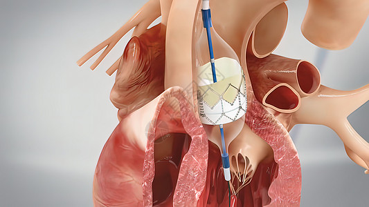 心脏支架背景气球高清图片