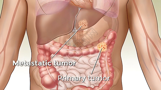 癌症的代谢性肿瘤扩散到身体的不同部位 从那里蔓延到流感结构免疫证书免疫系统生物学人体分子科学文件新生活图片
