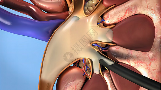 人体肾结石的历程学习肾病医疗疾病尿液肾脏微生物学身体生理器官背景图片