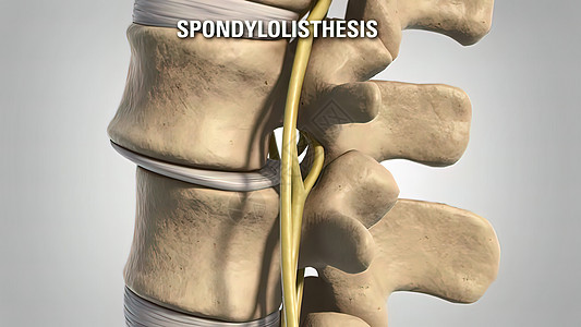 Lumbar 退化性疾病药品疼痛知识小路腰椎整脊光盘骨头注射身体图片