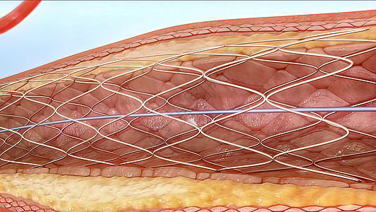 血管成形和血管牌匾动脉导管攻击模拟脂肪疾病干涉支架分流图片