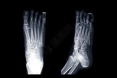 X光 右脚图象APAP 斜形和平面夹板教育脚趾长方体诊断高跟鞋扫描疼痛技术员咨询图片