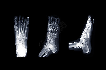 X光 右脚图象APAP 斜形和平面诊断科学考试放射科辐射跖骨骨骼骨科创伤教育图片