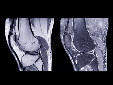 磁共振成像或MRI膝盖比较人表PDW和TIW视图医院股骨扭伤诊所核磁共振射线积液磁铁创伤软骨图片