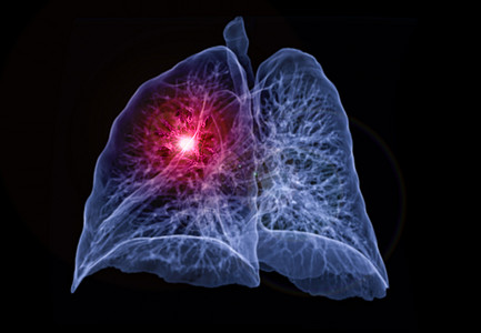 CT 肺3d 肝脏成象肋骨辐射心血管药品结节肺炎科学ct电脑诊断图片
