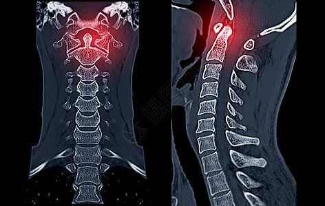 比较CT C脊椎或宫颈脊椎3D成像和人形图象脖子病人颅骨疝气考试痛苦脊柱创伤椎骨放射科图片