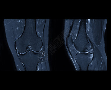 与磁共振膝盖或膝合磁共振成像相比 可刺激脂肪抑制的轴 人形和冠状观察技术医院肌肉放射科保健创伤运动疼痛股骨扫描诊断图片