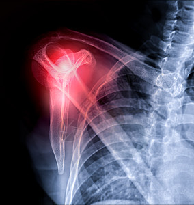 X射线肩膀合肩穿梭式观察 以诊断肩臂关节骨折症状骨骼器官创伤休息骨科肩胛骨医疗诊所疼痛图片