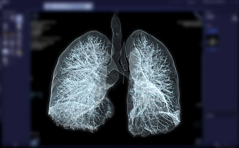 CT 胸腔或肺3D为诊断结果提供图象 肺结核 结核病和宫颈19癌症结核疾病心脏病学药品解剖学电脑放射科断层结节背景图片