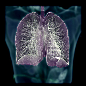 CT Chest 或 Lung 3D 在模糊的人体背景上拍摄图象 用于诊断肺结核 结核病和共生19图片