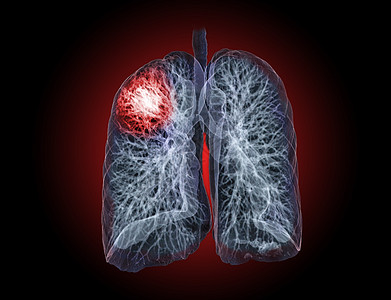 CT切斯特或肺3D选择性地聚焦于TB 肺结核和共生19的诊断监视器电影结节胸椎药品科学医院心脏病学疾病电脑结核图片