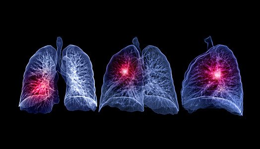 CT 肺3d 肝脏成象药品诊断屏幕辐射器官病人肺炎断层监控呼吸系统图片