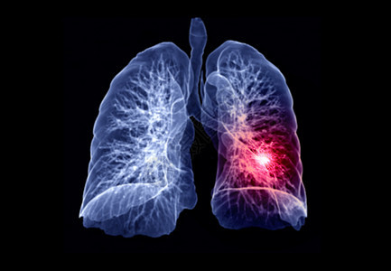 CT 肺3d 肝脏成象器官肋骨屏幕病人医生诊断胸部监控心脏病学哮喘图片