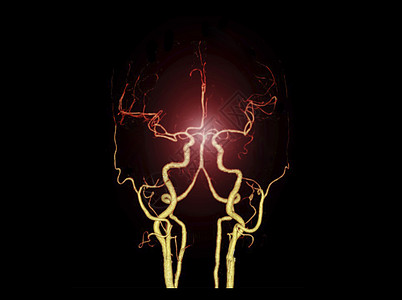 大脑计算CTA BRIAIN 或CT脑3D成像图显示脑动脉头痛3d系统辐射颅骨检查技术背景扫描仪血液循环背景