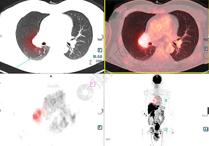 PET 胸部扫描图像图片