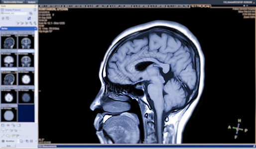 核磁共振脑剖面T1视图 用于检测大脑的各种状况 如囊肿 肿瘤 屏幕上隔离的出血等图片