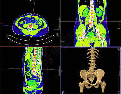 CT 腰椎或 LS 脊柱 3D 渲染图像 AP 冠状 矢状视图和 3D 渲染的集合图片