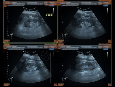 上腹部超声波检查显示肝脏 胆囊和肾 以筛查腹部疾病膀胱小腹药品放射科脓肿诊断考试检查异质身体图片