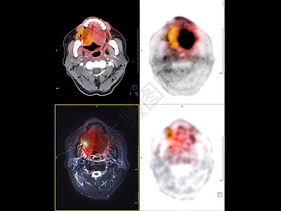 PET CT Neck图象显示PET CT扫描仪的CA 鼻喉或鼻腔癌ct扫描癌症医院机器放射科考试专家人脑科学图片