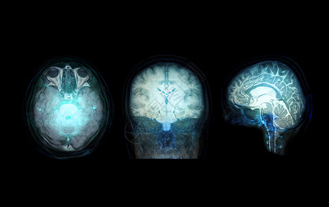 以大脑为主的  Skull  透明图像用于医学背景概念脑血管病人颅骨射线核磁共振医院疾病药品治疗动脉图片