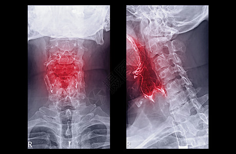 Esophagram或Biamor 燕子AP和横向视图显示食道 用于诊断GERD或气旋性回流疾病和眼癌图片