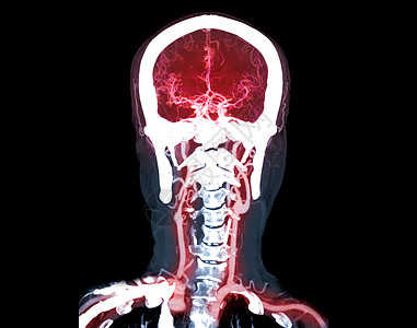 收集CTA大脑或CT脑血管成像图 比较Mip技术用于检测脑动脉的轴视断层医院检查药品考试ct动脉科学扫描放射科图片