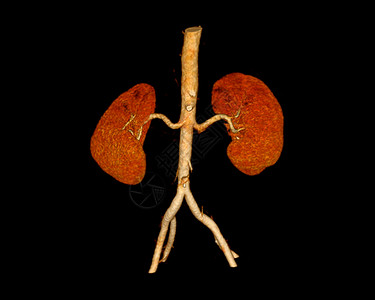 CTA 红动脉3D成像显示两个肾脏图片