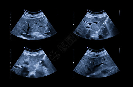 超声波上腹部显示肝脏和胆囊 用于筛查肝细胞癌和凝石诊断解剖学病人积液回声扫描检查脓肿胰腺卵巢图片