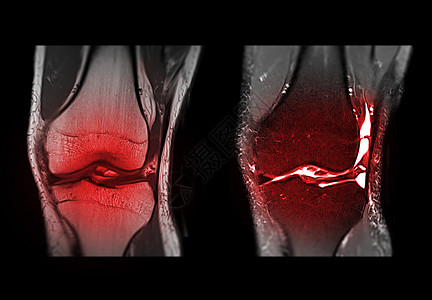 MRI 膝下冠日冕视图卫生技术骨科放射科创伤软骨核磁共振肌肉谐振射线图片