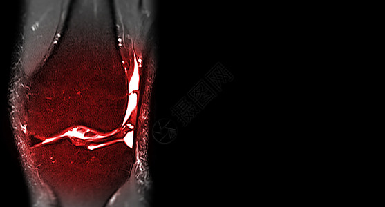 MRI 膝下冠日冕视图卫生末端医院扫描器创伤磁铁诊断放射科肌腱疼痛图片