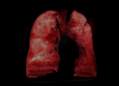 CTScanner 3D的肺三维成像用于诊断肺结核 结核病和共生19断层扫描仪科学肺部ct扫描放射科医院病人射线图片