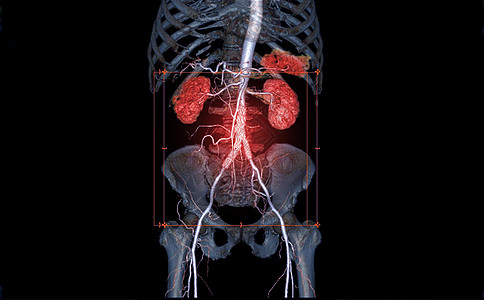 CTA 全Aorta 3D翻译图片