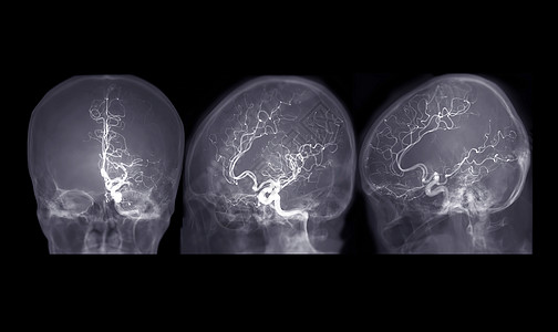在显示脑动脉的干预放射学中 来自氟透镜的脑血管造影AP 天蓝色和横向视图图像血块动脉荧光镜外科医院诊断放射科手术疾病大脑图片
