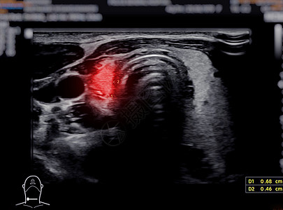 用于甲状腺诊断的甲状腺超声波光谱学扫描器脖子癌症医院程序考试甲减甲状腺炎技术扫描图片