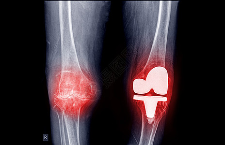 膝关节炎病人的膝盖和与膝盖替换的人工结合 分别是膝上X射线图片