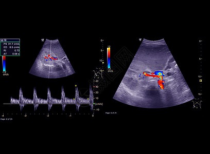 使用颜色多普勒后 超声波上部腹膜在普通大气管中出现流动图片