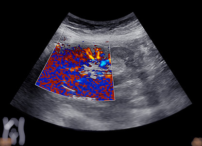 上腹部超声波显示肾脏检查脓肿胰腺疾病超声解剖学考试感染药品小腹图片