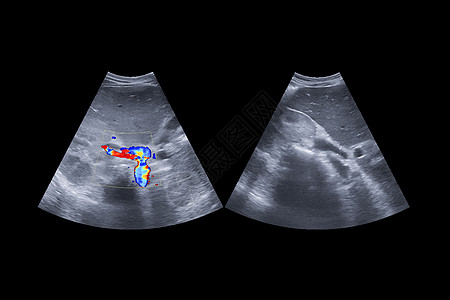 显示肝细胞系统解剖以及用于筛查Hcc剪切路径肝细胞癌的活性囊和胆囊的外声上部腹部超声道图片