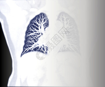 为诊断肺栓塞(PE) 肺癌和 Covid-19提供CT切斯特科洛纳尔核磁共振观察的选择性焦点图片