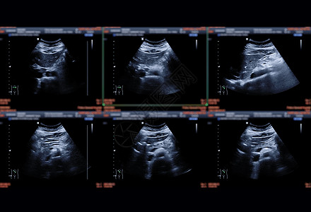 超声波上腹部显示肝脏 孩子 胰腺和胆囊 以便检测出高温热合金石或加仑石块图片