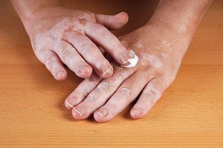 维蒂利哥皮肤科疾病医疗颜料白斑病非节段性病人补丁皮炎皮肤图片